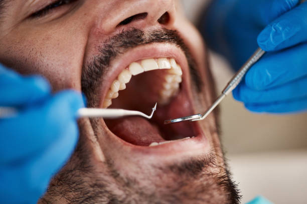 Best Emergency Dental Extractions in Stroud, OK